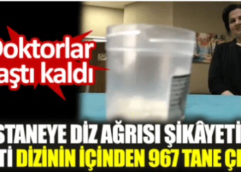 Doktorlar şaştı kaldı. Hastaneye diz ağrısı şikâyetiyle gitti dizinin içinden 967 tane çıktı