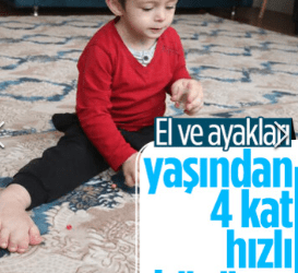 Bursa’da 4 yaşındaki çocuğun el ve ayakları orantısız büyüyor