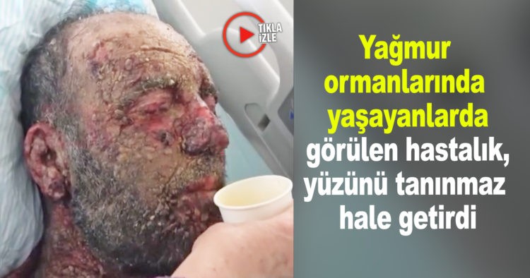 YAĞMUR ORMANLARINDA ÖZGÜ HASTALIK TÜRK’Ü BULDU