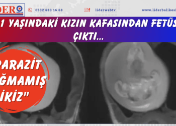 1 yaşındaki kızın kafasından fetüs çıktı… “Parazit doğmamış ikiz”