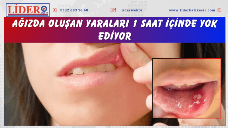 Ağızda oluşan yaraları 1 saat içinde yok ediyor