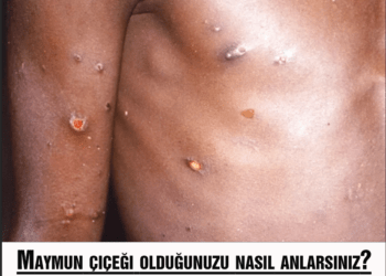 Maymun çiçeği olduğunuzu nasıl anlarsınız?