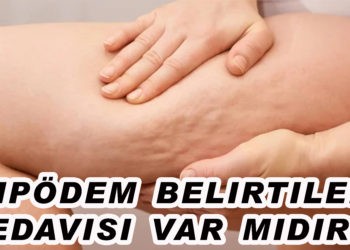 Selülit gibi görünen “lipödem” nedir, nasıl anlaşılır?