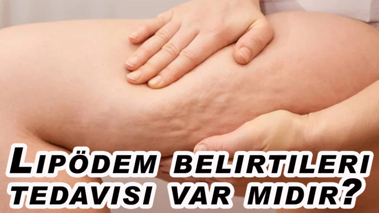Selülit gibi görünen “lipödem” nedir, nasıl anlaşılır?
