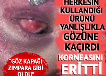 Kirpik yapıştırıcısı korneasını eritti!