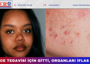 Sivilce tedavisi için gitti, organları iflas etti!
