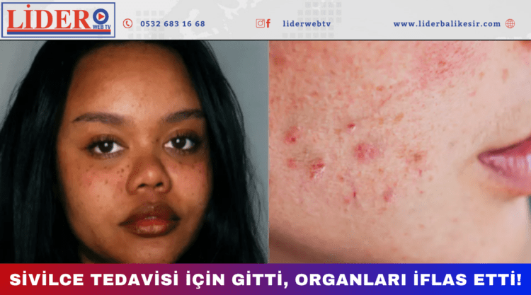 Sivilce tedavisi için gitti, organları iflas etti!